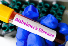 Photo of लक्षण दिखने से 10 साल पहले ही पता चल सकेगा अल्जाइमर का खतरा