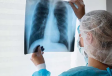 Photo of कमजोर इम्युनिटी और खराब जीवनशैली दे रही टीबी को न्योता